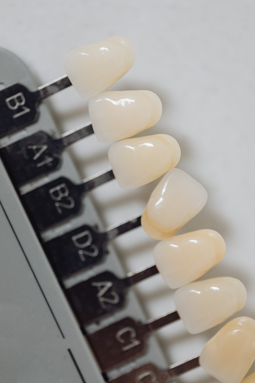 Close-up of Teeth Veneers